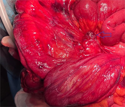 Hernia sac containing small bowl with the inflamed appendix.