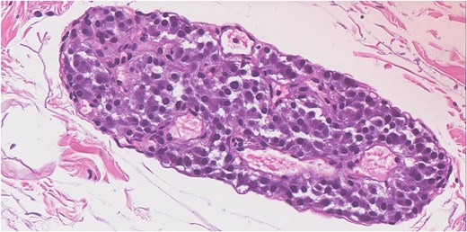 Hematoxylin and eosin stain show microscopic focus in the adventitial fatty tissue of a well-circumscribed aggregate of tightly packed nested epithelioid cells. The neoplastic cells have amphophilic cytoplasm with round nucelli and fine chromatin.