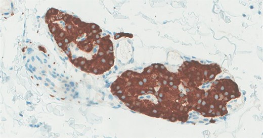 The neoplastic cells are positive for synaptophysin immunohistochemical stain.