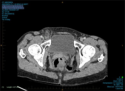 Coronal CT reported as an Amyand’s hernia.