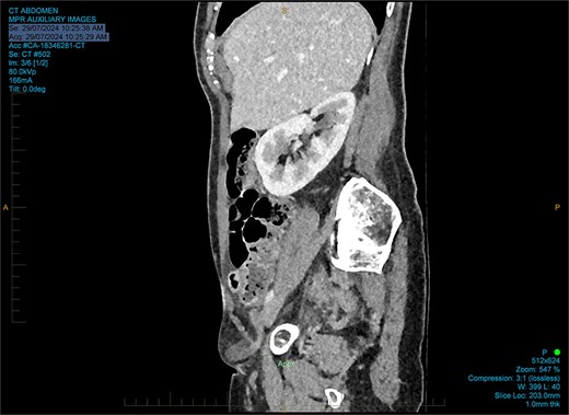 Sagittal CT reported as an Amyand’s hernia.