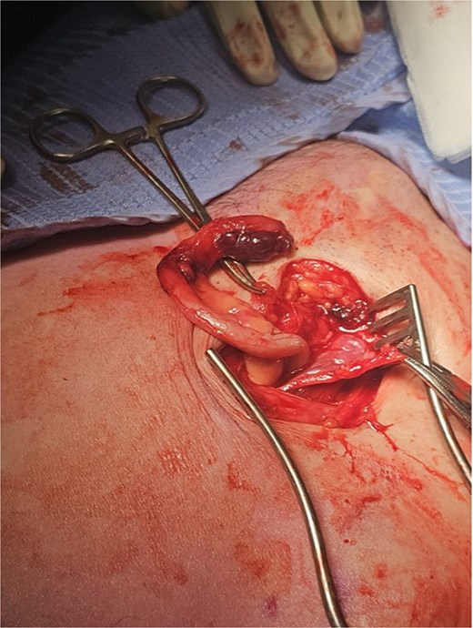 Inflamed appendix in femoral hernia.