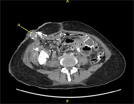 CT contrast abdomen and pelvis showing spill of barium outlining the peritoneal cavity. Stoma at the right side of the abdomen (A).