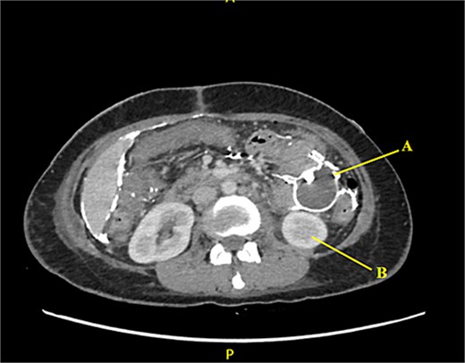 Barium-lined intra-abdominal collection (A) anterior to the left kidney (B).