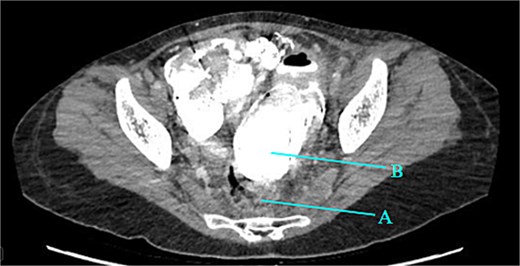 Rectum (A) large barium containing pelvic collection anterior to the rectum, the drain was placed in this collection (B).