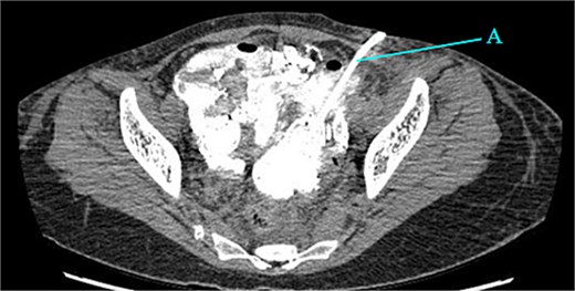 Drain placed in the collection (A).