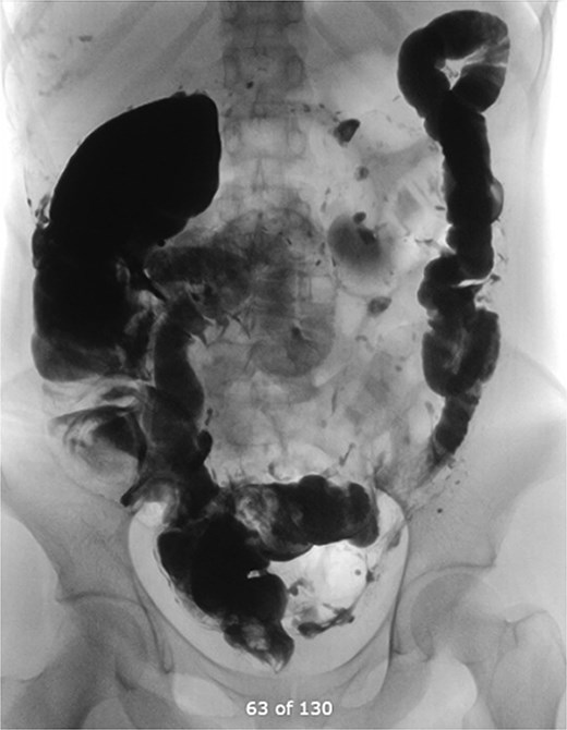 Distal loopogram showing free flow of contrast.