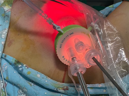 Surgical procedure.