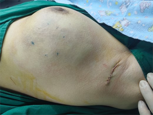 Scar display after surgery.