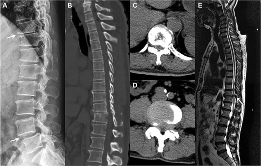 The preoperation imaging examinations. A sagittal X-ray (A) shows concomitant anterior displacement and instability of T10 and L4. A sagittal CT image (B) similarly demonstrates vertebral body slippage at T10, with stenosis and disc herniation of the spinal canal at the corresponding segments (C, D). T2-weighted imaging MRI (E) demonstrates severe spinal cord compression, with neurologic ischemic degeneration.