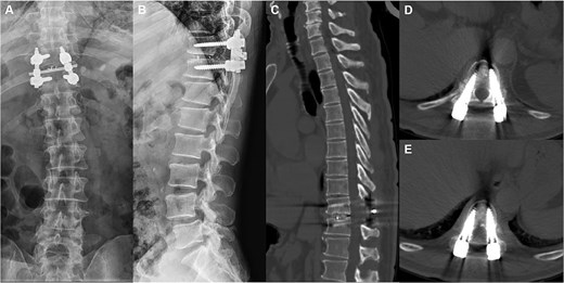 Postoperative X-ray and CT showed that the slipped thoracic 10 vertebra was reset, the internal fixation device was ideally positioned, and the spinal cord compression had disappeared.