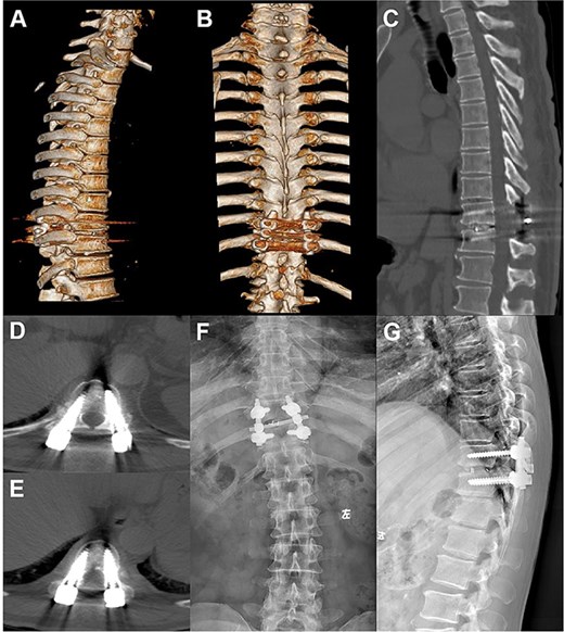 Postoperative follow-up images. (A–D) Repeat CT plain and 3D reconstruction at 6 months postoperatively showed ideal position of the T10–11 internal fixation and fusion device, straight posterior margin of the vertebral body, and no obvious signs of compression of the dural sac. (E, F) Review X-ray at 1 year postoperatively showed that the internal fixation device was in place without obvious dislocation, and the vertebral body slippage was satisfactorily repositioned.
