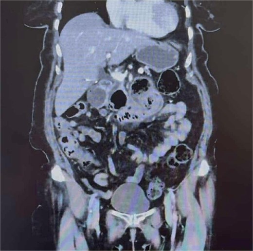 CT abdomen and pelvis demonstrating a partially obstructing intraluminal lesion at the duodeno-jejunal junction, adjacent to an inflamed duodenal diverticulum raising suspicion for an impacted food bolus, a mass lesion or intussusception. There was no evidence of perforation, free gas, or fluid.