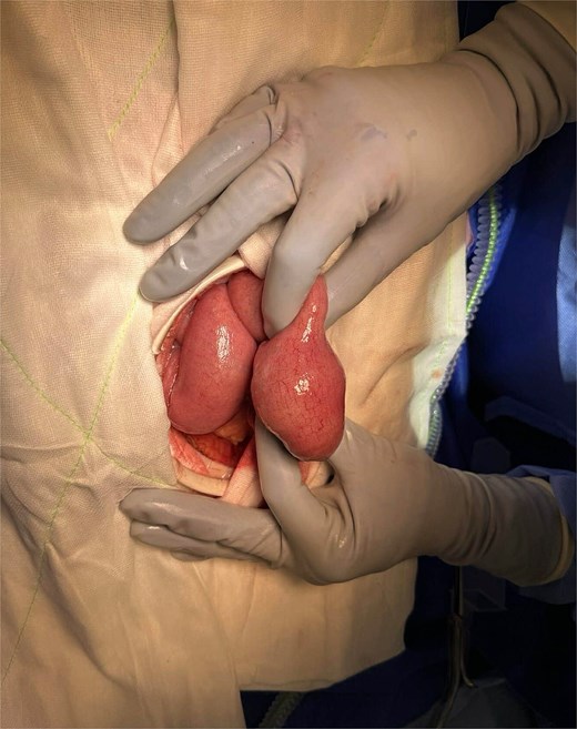 Intraoperative image of segment of small bowel containing enterolith.