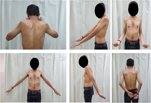 Clinical pictures of both shoulder before surgical treatment.