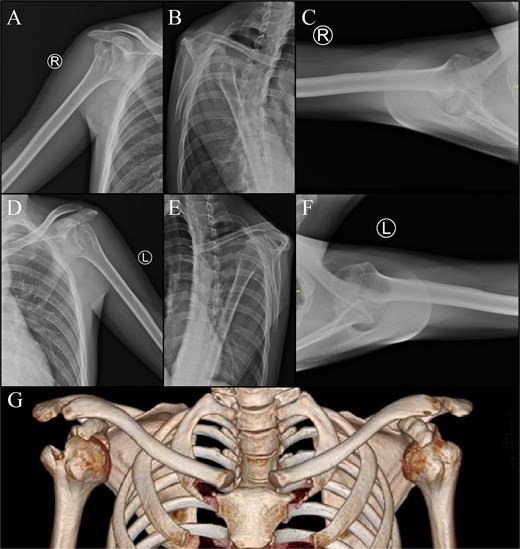 Imaging of the right shoulder : (A) anteroposterior view; (B) scapular Y view; (C) axillary view. Imaging of the left shoulder : (D) anteroposterior view, (E) scapular Y view, (F) axillary view. (G) 3D computed tomography scan.