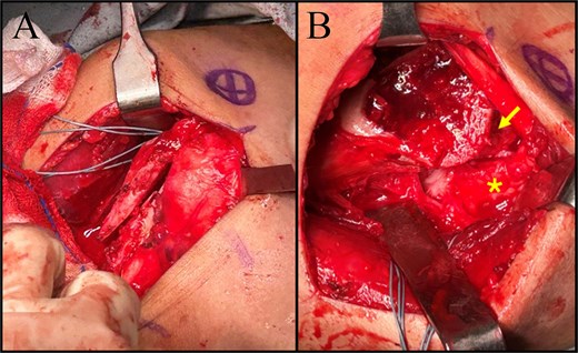 Intraoperative images. (A) Greater tuberosity osteotomy. (B) Exposed glenoid (asterisk) and Hill-Sachs lesion (arrow).