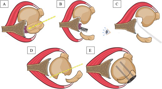 Surgical technique illustrations. (A) Greater tuberosity osteotomy to the old unreduced malunion fracture dislocation of proximal humerus. (B) Direct visualization to the posterior capsule, allowing accessible adhesion and fibrosis removal. (C) Humeral head reduction using levering mechanism. (D) Removal of the Hill-Sachs lesion. (E) Greater tuberosity fixation using proximal humerus internal locking system plate.