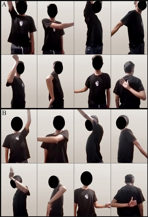 (A) Right shoulder range of movement 1-year post-surgery and (B) left shoulder range of movement 9 months post-surgery.