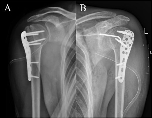 Post-operative radiographs: (A) right shoulder; (B) left shoulder.