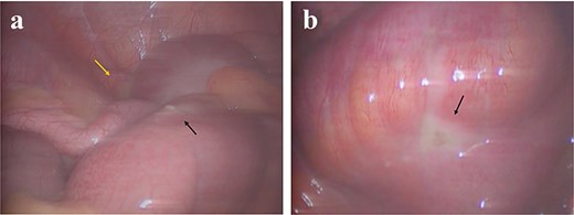 Intra-operative laparoscopic findings. (a) Approximately 15 ml of purulent fluid (yellow arrow) and the first ileal perforation (black arrow) in the right iliac fossa. (b) A second ileal perforation (black arrow) identified in an adjacent loop.