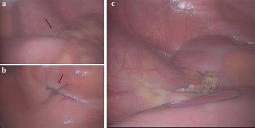 Intra-operative management. (a and b) Laparoscopic full-thickness suture closure (black arrow) of the two ileal perforations. (c) Completed laparoscopic appendectomy.