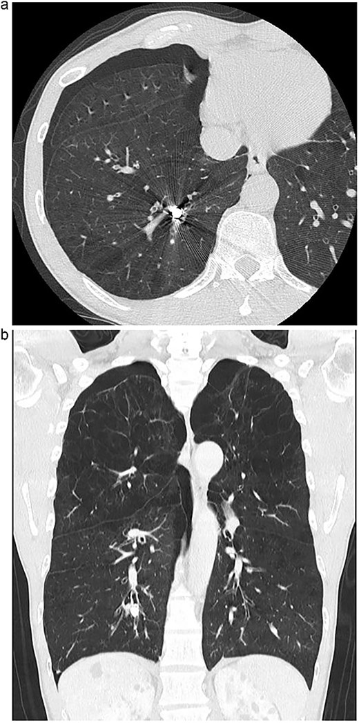 (a) Axial chest CT showing a high-density foreign body in the right S10 bronchus. (b) Coronal CT confirming the position of the dental prosthesis in the posterior basal segment.