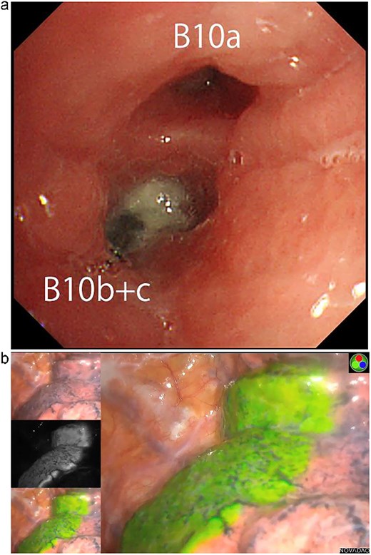 (a) Bronchoscopic image showing impacted dental prosthesis in the B10b+c bronchus. (b) Intraoperative near-infrared fluorescence image visualizing the intersegmental plane after ICG bronchial injection.