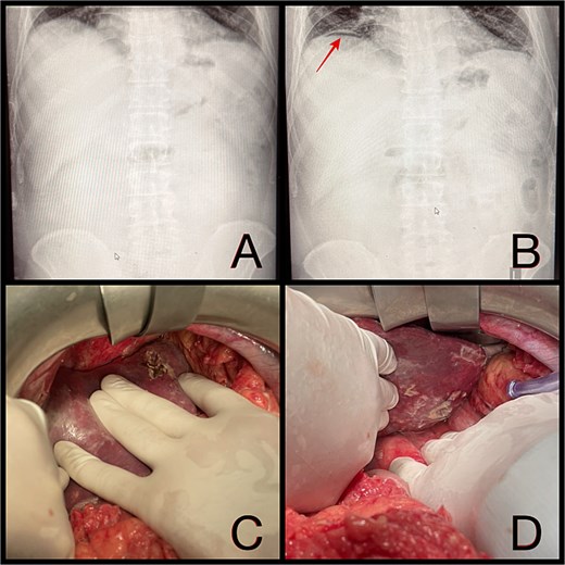 (A and B) Abdominal radiographs showing progression from no free gas (A) to a crescent of pneumoperitoneum beneath the right hemidiaphragm (B, arrow) within 2 hr. (C and D) Intraoperative findings of a ruptured pyogenic liver abscess in segment II, perforating both the diaphragmatic and visceral hepatic surfaces.