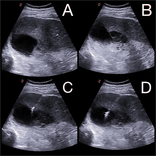 (A and B) Abdominal ultrasound depicting a 9 × 5 cm abscess in segment VII. (C and D) Percutaneous drainage performed with placement of a 10 Fr catheter under ultrasound guidance.