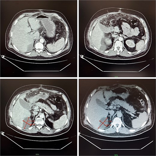 Contrast-enhanced abdominal CT on postoperative day 14, demonstrating a 9 × 5 cm abscess in segment VII.