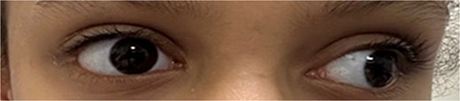 Preoperative image with the patient looking at distance.
