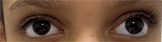 Preoperative image with the patient looking near.