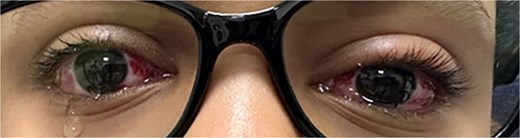 First day postoperative image with the patient looking at distance