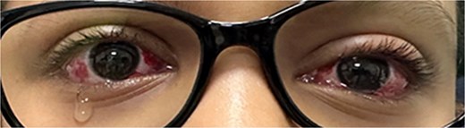 First day postoperative image with the patient looking at near (orthophoria with alternate prism and cover test).