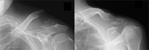 Radiographs captured immediately after injury show a fracture of the left distal clavicle with displacement.