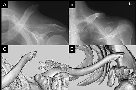 Radiographs (A and B) and CT scans (C and D) captured after 5 months of conservative treatment show that the displacement has progressed.
