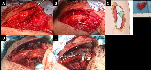 Intraoperative findings of the left clavicle. The proximal (double asterisk) and distal (asterisk) fragments (A) at the site of nonunion are exposed. After being reduced, the fragments are fixed using a Kirschner wire and a triangular column-shaped bone defect is identified at the site of nonunion (B). A shape-matched bicortical bone graft is harvested from the iliac wing (C). After bone grafting (dagger) (D), a scorpion plate is used for fixation (E).