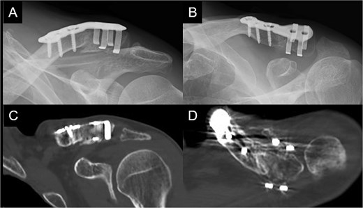 Radiographs (A and B) and CT scans (C and D) captured at 1 year postoperatively show union of the bone.