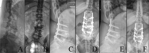 Last preoperative X-ray, lateral (A) and anteroposterior view (B). After 10 weeks of follow-up; lateral (C) and anteroposterior view (D). After 1 year of follow-up; lateral (E) and anteroposterior view (F).