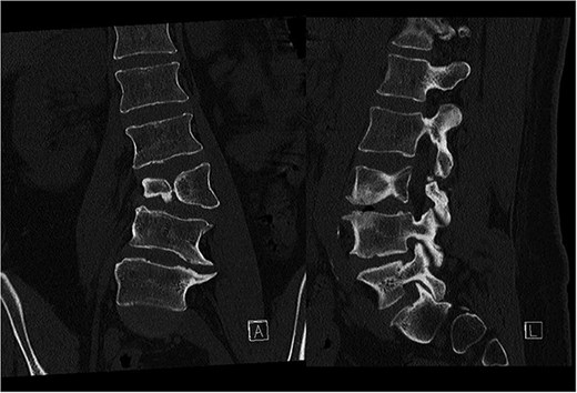 Preoperative CT demonstrating L3 hemivertebra; anteroposterior view (A) on the left side of the image, and lateral view (L) on the right side of the image.