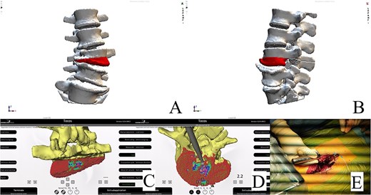 Resection plan, anteroposterior view (A). Resection plan, lateral view (B). Posterior and underside view of real-time intraoperative control of our preoperative plan; colored dots represent the planned resection area (C and D). Intraoperative check of the resection with the navigated probe (E).