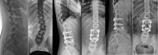 Last preoperative X-ray, lateral (A) and anteroposterior view (B). After 10 weeks of follow-up; lateral (C) and anteroposterior view (D). After 1 year of follow-up; lateral (E) and anteroposterior view (F).