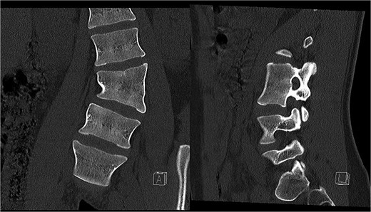 Preoperative CT demonstrating L3 hemivertebra; anteroposterior view (A) on the left side of the image, and lateral view (L) on the right side of the image.