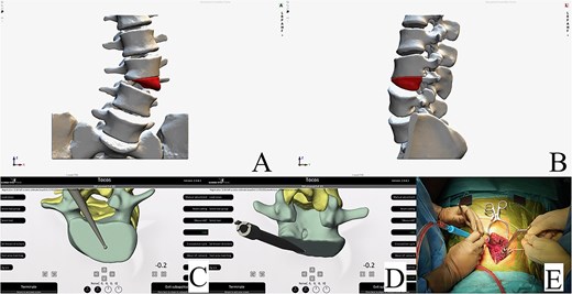 Resection plan, anteroposterior view (A). Resection plan, lateral view (B). Underside and posterior view of real-time intraoperative control of our preoperative plan; resection margin check with the navigated probe (C and D). Intraoperative view of the posterior hemivertebra resection (E).