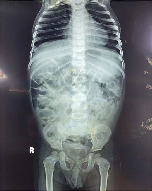 Anteroposterior abdominal radiograph demonstrating diffusely air-distended small bowel loops consistent with a partial small bowel obstruction. No significant air-fluid levels or evidence of pneumoperitoneum is visible.