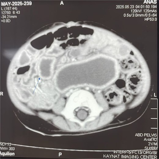 Contrast-enhanced axial CT scan of the abdomen. The image reveals a well-defined, thick-walled cystic lesion (arrow) located along the mesenteric border of the midgut. The lesion demonstrates peripheral post-contrast enhancement without internal septations or solid components, findings highly suggestive of a jejunal duplication cyst.