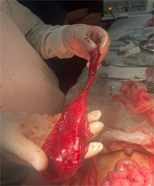 Intraoperative picture showing the removed non-communicating proximal cyst.