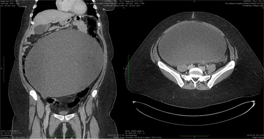 CT scan showing ovarian cyst compressing the small bowel in the epigastrium (longitudinal and transversal section).