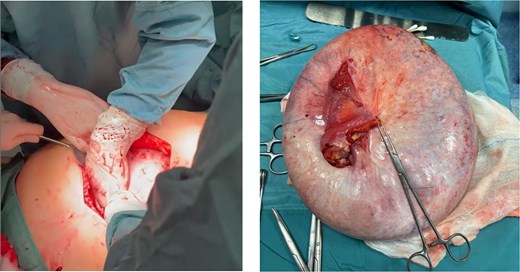 (a) Mini-laparotomy (about 25 cm) for removal of the lesion. (b) Intact surgical specimen.